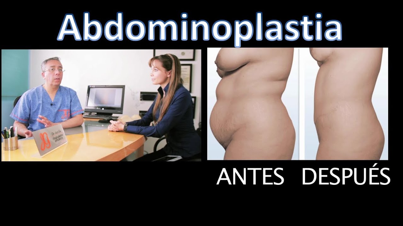 Abdominoplastia Todo lo que necesita saber | Postoperatorio, Cicatrices, Fotos antes despues, video