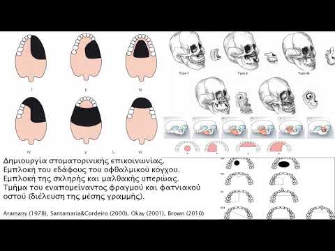 Γναθοπροσωπική προσθετική αποκατάσταση ογκολογικών ελλειμμάτων άνω γνάθου. Προβληματισμοί και λύσεις.
