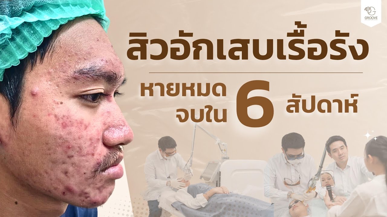 รีวิวรักษาสิว