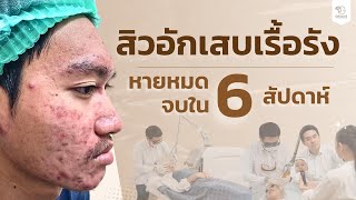 สิวซีสต์ คุณก้าน