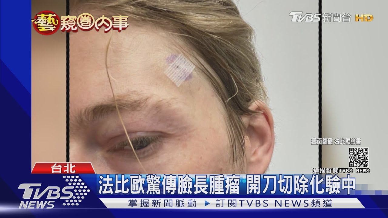 法比歐驚傳臉長腫瘤 開刀切除化驗中