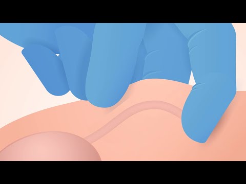No Scalpel Vasectomy Animation: Technically accurate