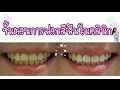 ขั้นตอน