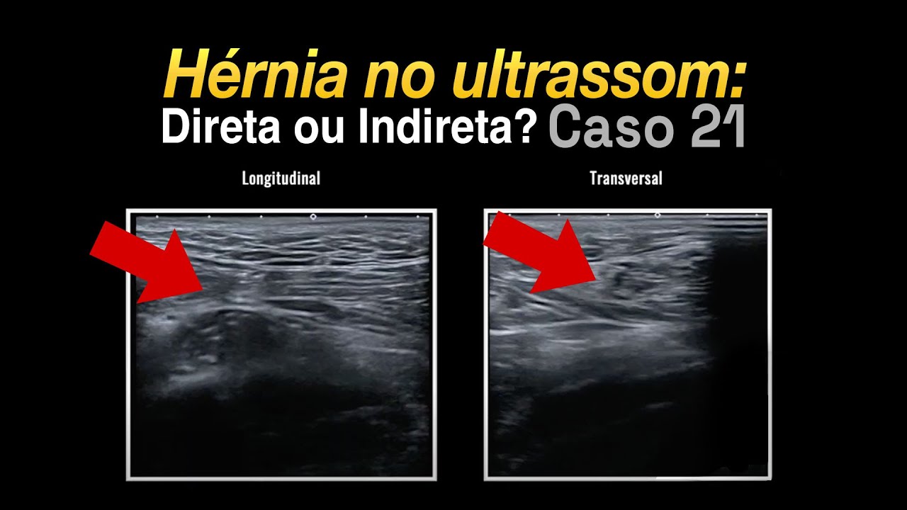 Ultrassom da Região Inguinal: Hérnia? Direta ou Indireta? Caso 21 PHD