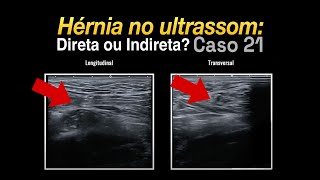 Ultrassom da Região Inguinal: Hérnia? Direta ou Indireta? Caso 21 PHD