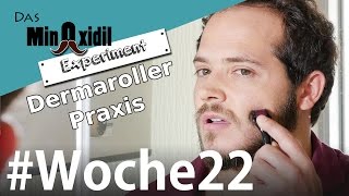 Das Minoxidil Experiment #Woche22 Dermaroller Praxis