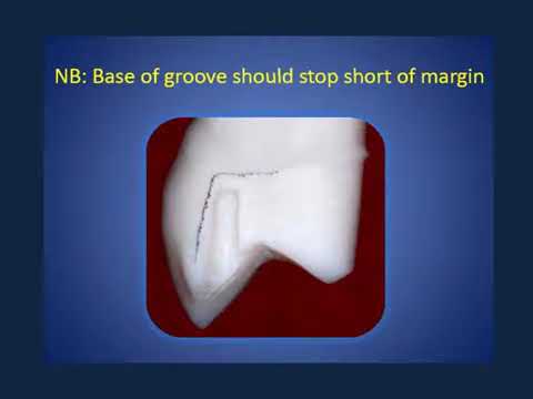 Crown&bridge/ partial veneer crown/ 3rd stage 🦷 LEC7
