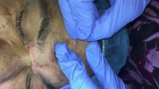 Managing Ethnic skin (Extractions Part 1)