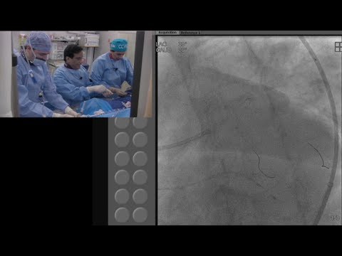 (20 min CCC Jan '19) - Revascularization of Calcific LM Bifurcation