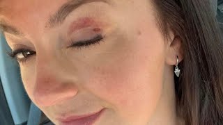Hannah Barron accident ! What happened to Hannah Barron #accident #dress #outfit #fitness #gym 