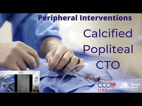 Calcified Popliteal CTO