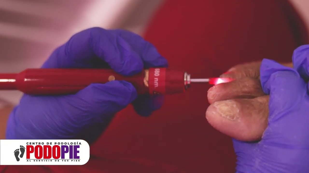TRATAMIENTO LÁSER ONICOMICOSIS