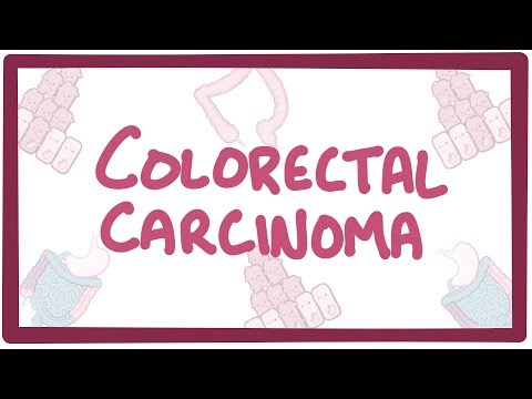 Cancer colorectal nonpolipozic