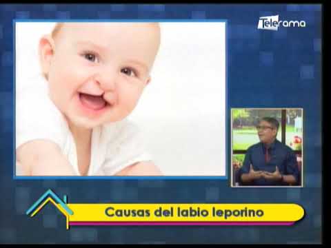 Causas del labio leporino 