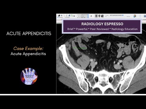 ACUTE APPENDICITIS: Case Example - Acute Appendicitis on CT (4410)