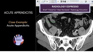 ACUTE APPENDICITIS: Case Example - Acute Appendicitis on CT (4410)
