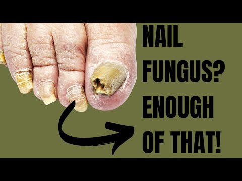 Pedicure Secrets: Learn the Best Ways to Prevent and Cure Nail Fungus