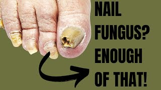 Pedicure Secrets: Learn the Best Ways to Prevent and Cure Nail Fungus