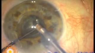 Pseudoexfoliation cataract surgery + fako + iol