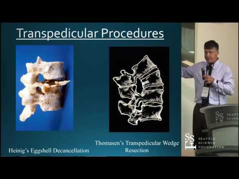 Spinal Deformity Surgery - Sigurd Berven, MD