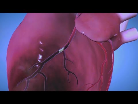 Anatomy of Heart Attack