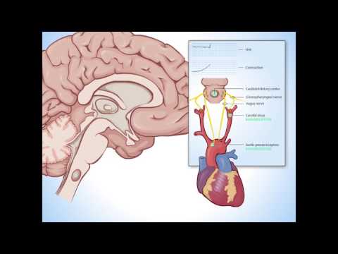 Variable Decelerations - Fundamentals of Fetal Health Survelliance