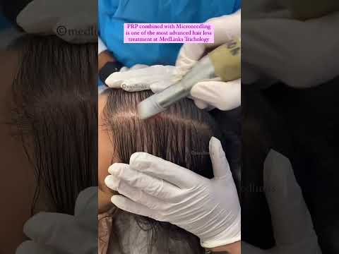 🔥PRP ( Platelet-Rich Plasma ) Best Hair Treatment | #shortsfeed #shorts