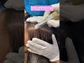 PRP Platelet Rich Plasma Best Hair Treatment Shortsfeed Shorts