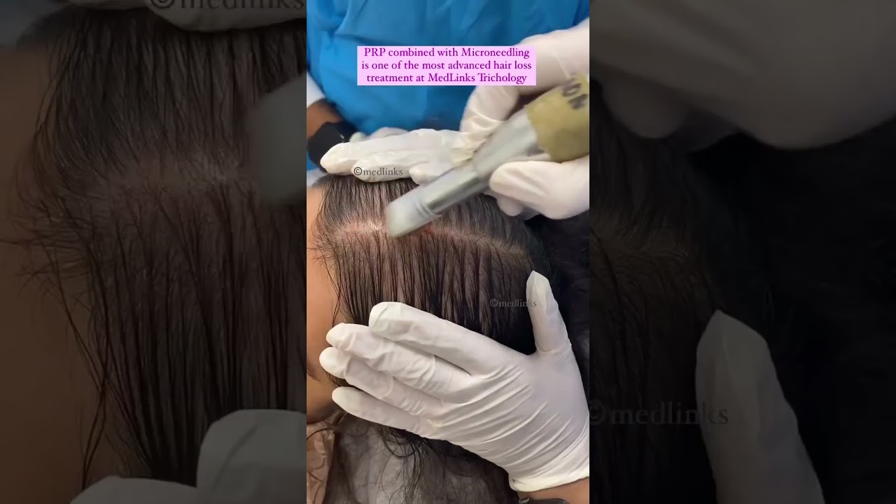 🔥PRP ( Platelet-Rich Plasma ) Best Hair Treatment | #shortsfeed #shorts
