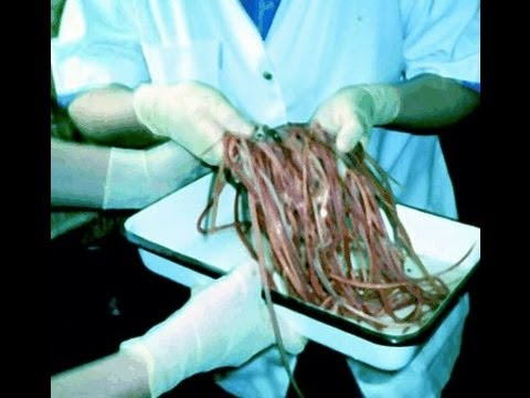 Removing intestinal worms & parasites from a bodybuilders colon re: