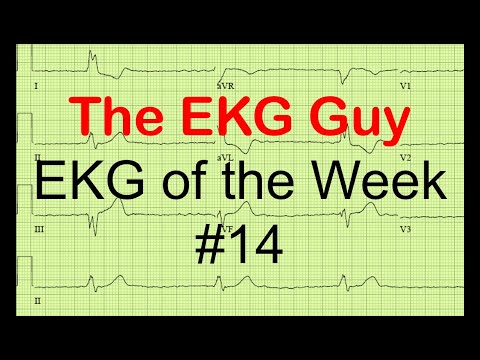 EKG/ECG of the Week #14 | The EKG Guy - www.ekg.md