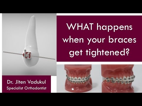 WHAT happens when your braces get tightened?  |  Dr. Jiten Vadukul  |  The Orthodontist