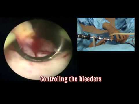 Bipolar TURP: How to complete the resection 