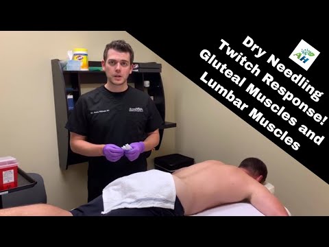 乾針刺激臀肌與下背肌的激痛點反應！ (Dry Needling Twitch Response Gluteal Muscles and Lumbar Muscles)
