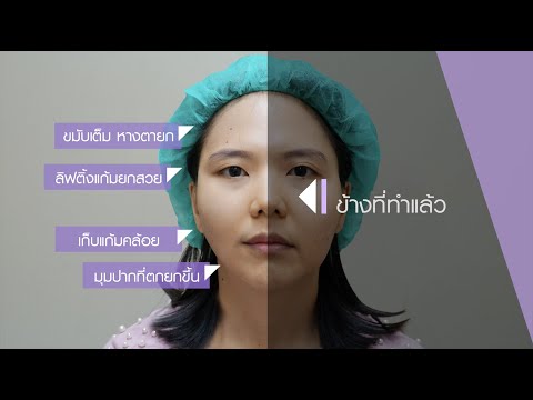 ร้อยไหม