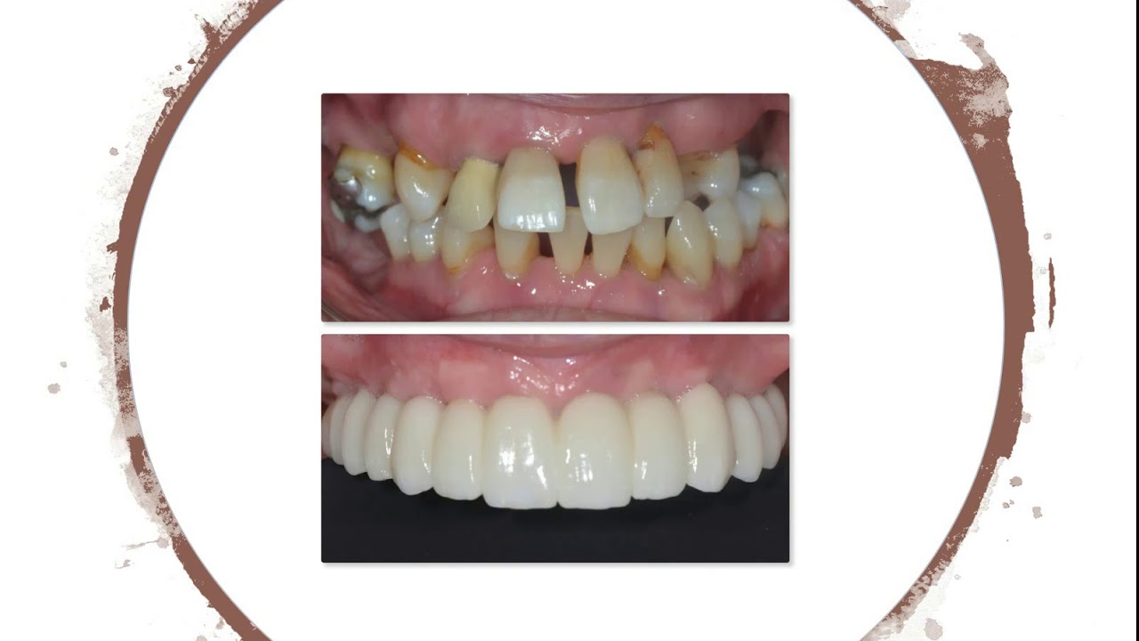 Same Day Teeth Dental Implants Leeds Infinity Dental Clinic