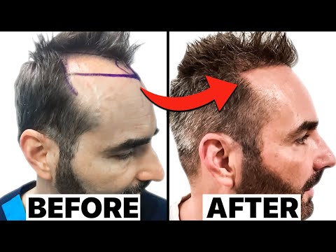 My SHOCKING 18 Months Hair Transplant Results |...