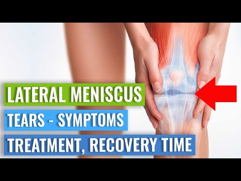 LATERAL Meniscus Tears: Symptoms, Treatment (Surgery vs. Exercise), & Recovery Time