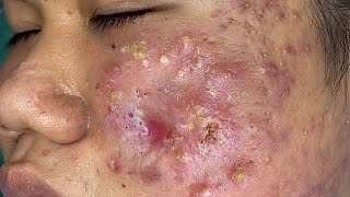 Espremendo Cravos e Espinhas - Relaxante e Satisfatório 😍