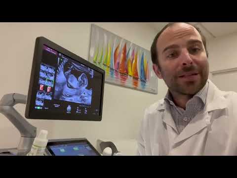 Premier trimestre de grossesse en échographie, morphologie et clarté nucale. Docteur T VERNET.