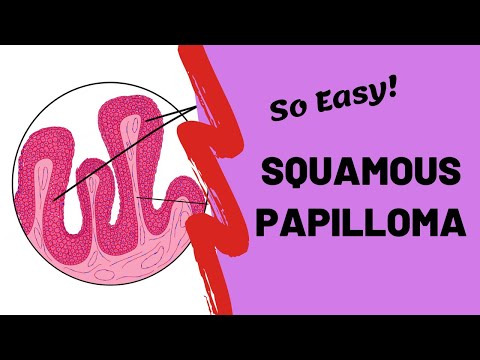 Squamous Papilloma | Oral Pathology Lectures