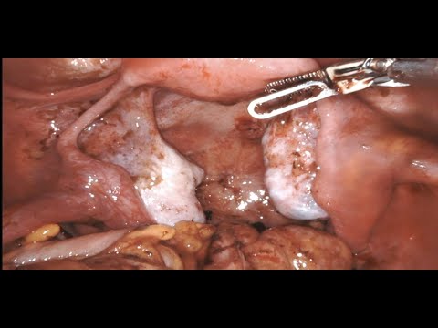 Excision of Bilateral Endometriomas