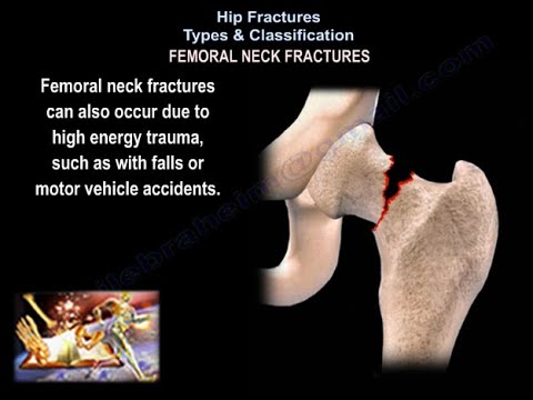 Hip Fractures Types & Classifications - Everything You Need To Know - Dr. Nabil Ebraheim