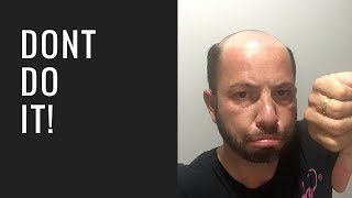 Hair Replacement Mens Hair System Review Dont Do It!!!!