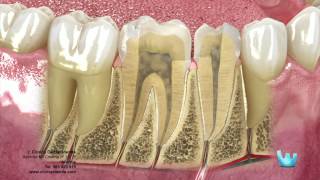 Endodoncia: desvitalizar el nervio dental