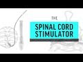 Implant Files: Spinal Cord Stimulator, Explained.