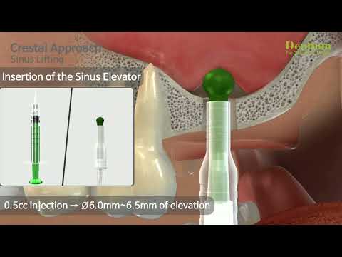 Dentium Total Solution for Sinus (Crestal Approach)