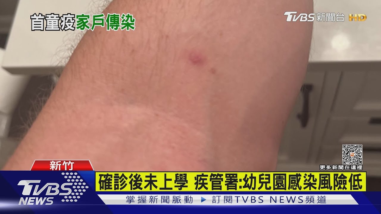 國內首例本土兒童猴痘 新竹4歲男童確診