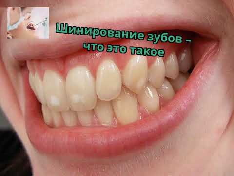 Шинирование зубов – что это такое