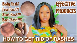 HOW TO GET RID OF RASHES| Face Rashes Back Rashes+ EFFECTIVE PRODUCTS THAT GETS RID OF RASHES